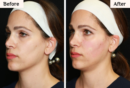 renuva facial filler before and after results